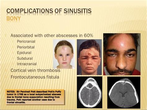 Potential Complications of Sinus Infections