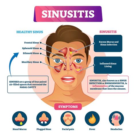 Understanding Sinus Infections