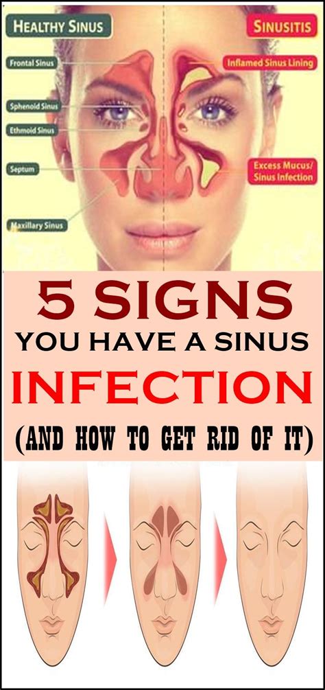 Sinus pressure symptoms