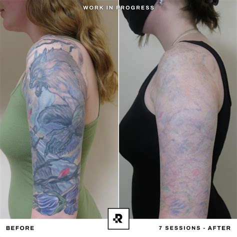 sleeve tattoo removal