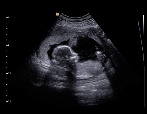 Sonogram image of a thyroid gland