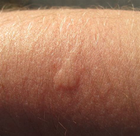 5 Ways to Soothe Bug Itch