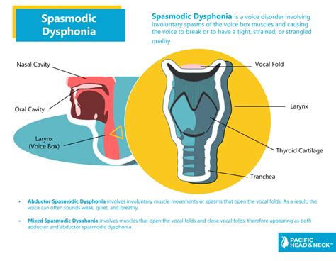 Causes of spasmodic dysphonia