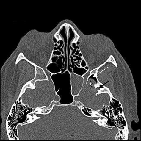 CT Scan of Sphenoid Sinus