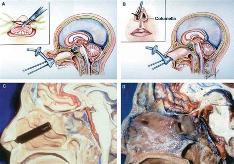 Surgical Intervention for Sphenoid Sinus Infections