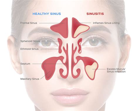 Symptoms of Sphenoid Sinus Infection