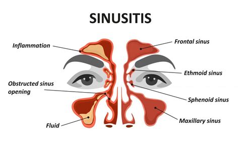 Sphenoidal Sinuses Allergens