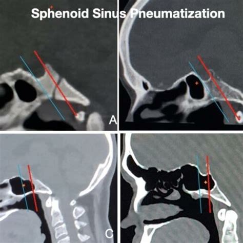 Sphenoidal Sinuses Smoking