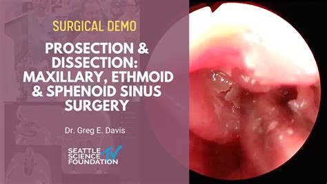 Sphenoidal Sinuses Surgery