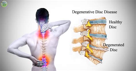 Spinal Degenerative Changes