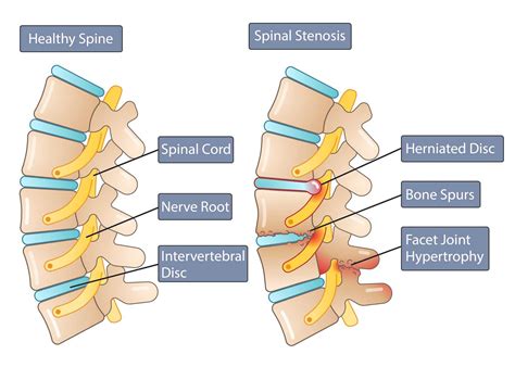 Spinal stenosis illustration