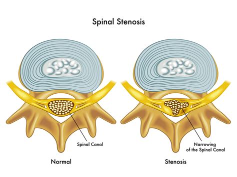 Spinal Stenosis Diagram