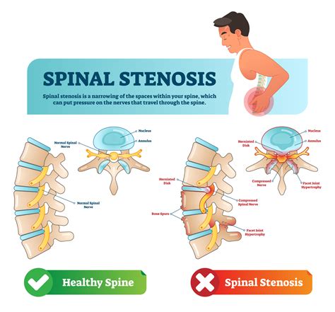 Spinal stenosis treatment options