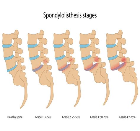 Spondylolisthesis illustration