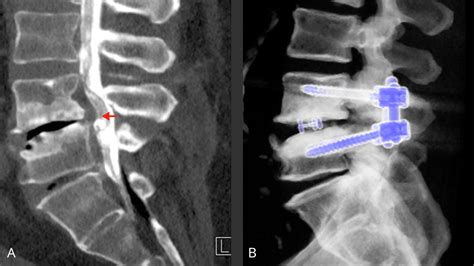 Spondylolisthesis surgery