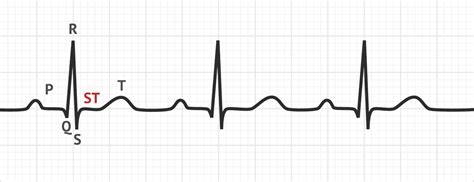 ST segment EKG interpretation