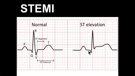 ST segment elevation EKG interpretation