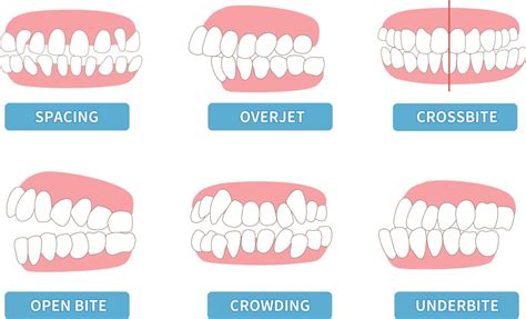 Steps Involved in Bledsoe Braces Treatment