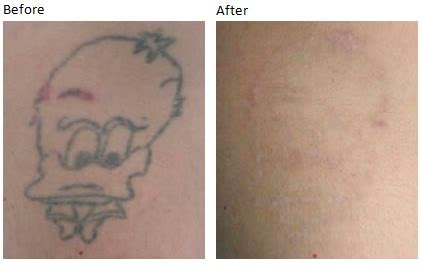 Steps Involved in Clearit Tattoo Removal