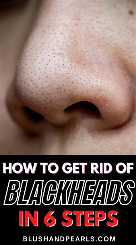 Steps to Remove Blackheads