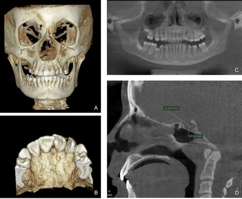 Supraorbital Ridge Forensic Science