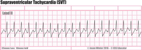 Supraventricular Tachycardia EKG