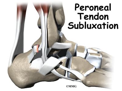 Surgery for Subluxation