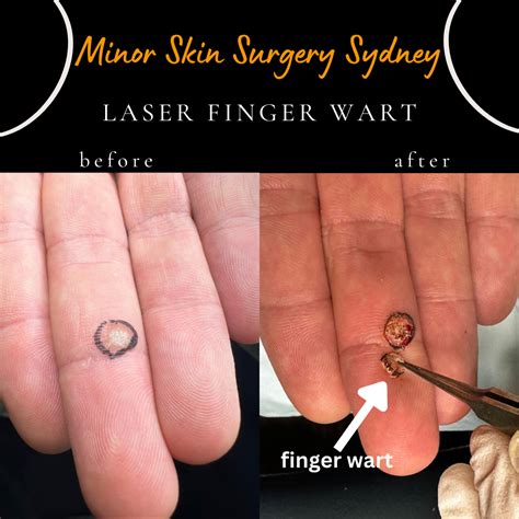 Surgical excision for wart removal