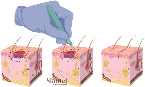 Surgical excision method for tattoo removal