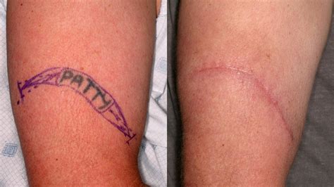 Surgical excision for tattoo removal