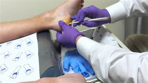 Surgical Removal of Plantar Warts