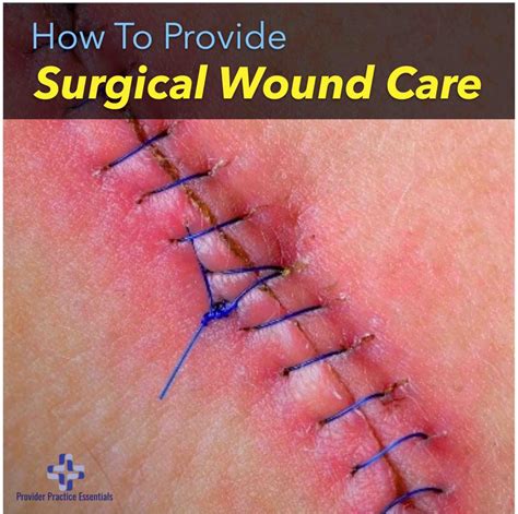 Surgical wounds treated with gel wound dressings