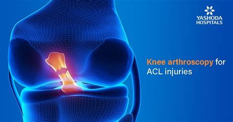 Symptoms of ACL injury