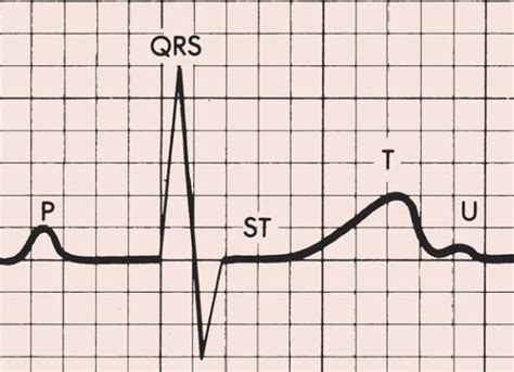 T-wave EKG interpretation