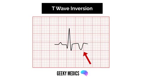 T-wave inversion EKG interpretation