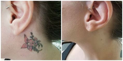 Tattoo Correction Methods