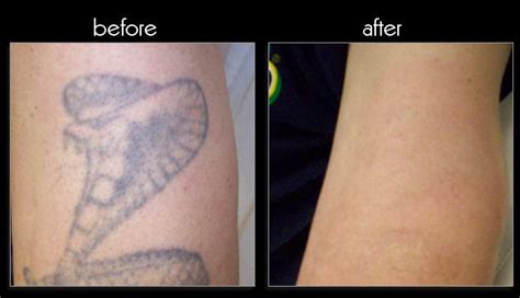 Tattoo cover-up patches skin tones