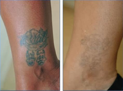 Tattoo Dermabrasion