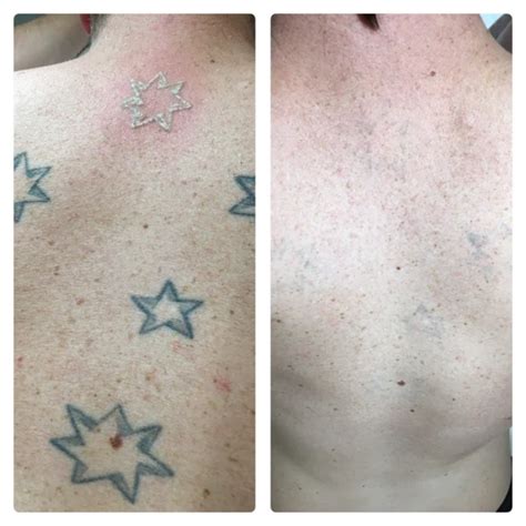 Tattoo fading solutions