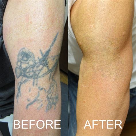 Tattoo Laser Removal