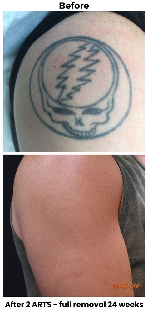 Tattoo removal and correction