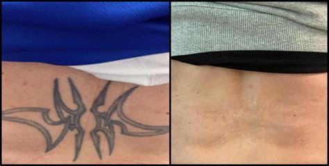 Tattoo removal benefits in Philadelphia