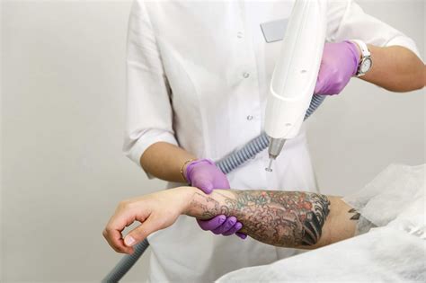 Tattoo removal clinic