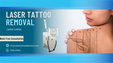 Tattoo removal clinics near me