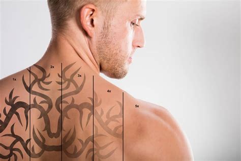 Cost of tattoo removal in Tijuana