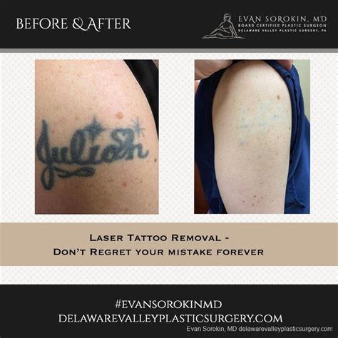 Tattoo removal dermabrasion