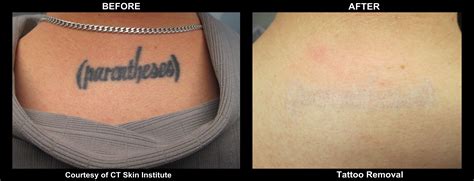 Tattoo removal effectiveness