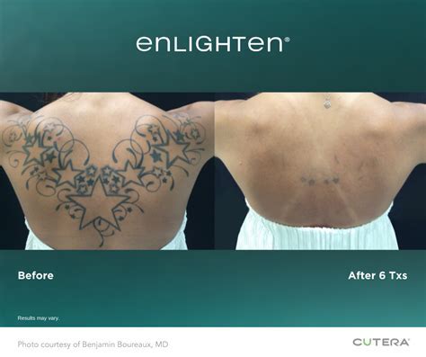 Tattoo removal experts in Raleigh, NC