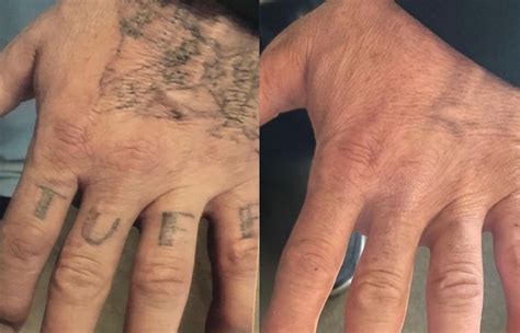 Tattoo removal experts