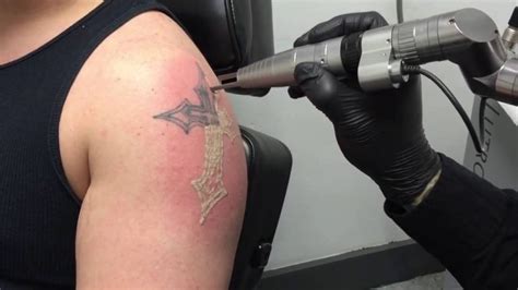 Tattoo removal healing